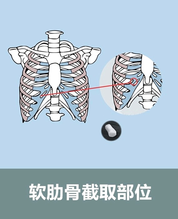 隆鼻哪种好自体肋软骨隆鼻安全吗