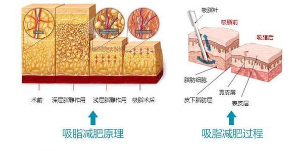 腰腹抽脂多久恢复自然