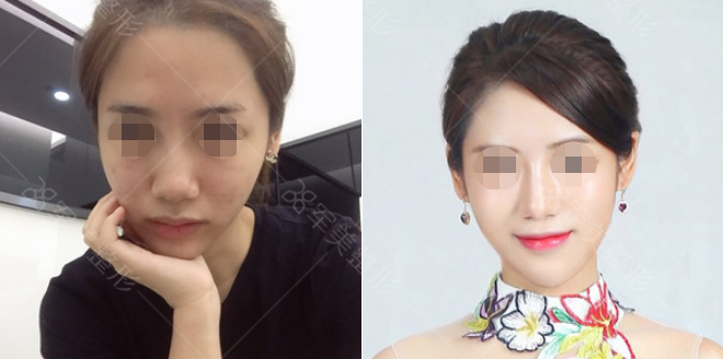 塌鼻子怎样变挺