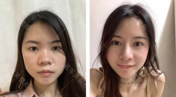 塌鼻子怎样变挺