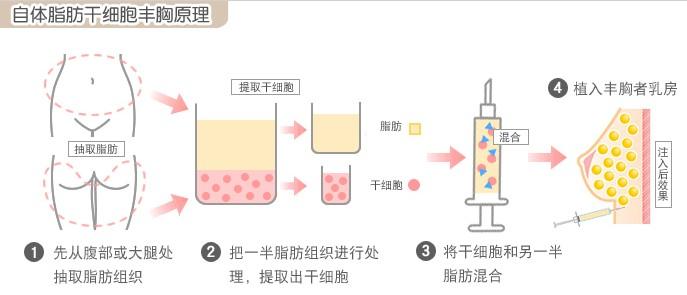 自体脂肪丰胸能一次成型吗