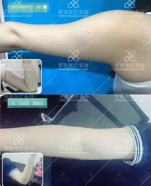 吸脂后凹凸不平如何修复