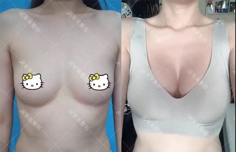 自体脂肪丰胸怎么样