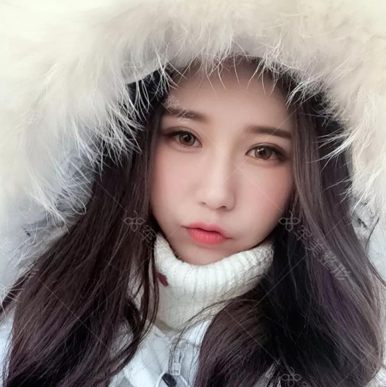  自体脂肪填充多久消肿