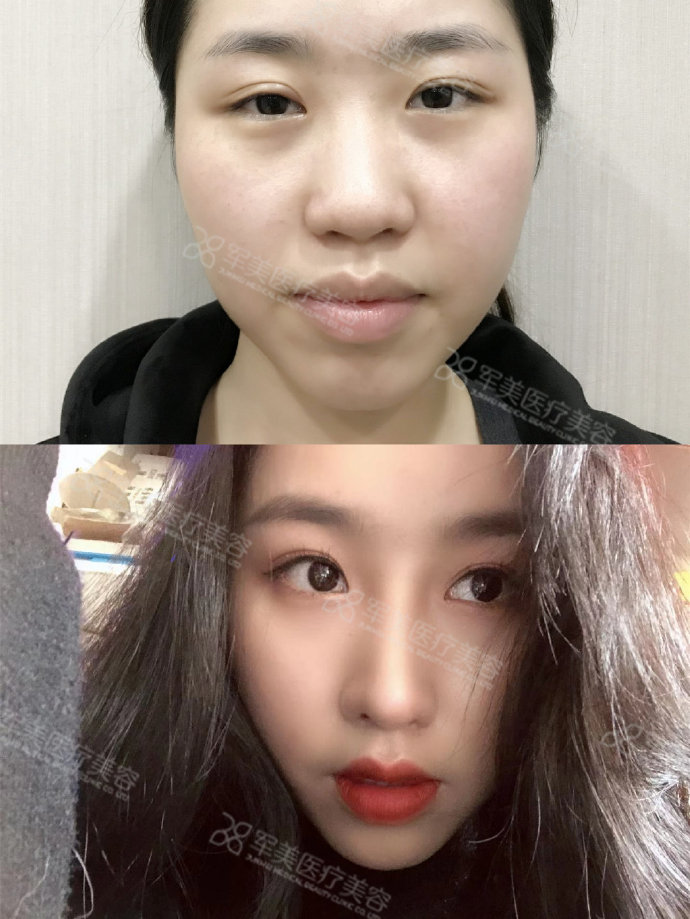鼻部修复手术需要注意什么