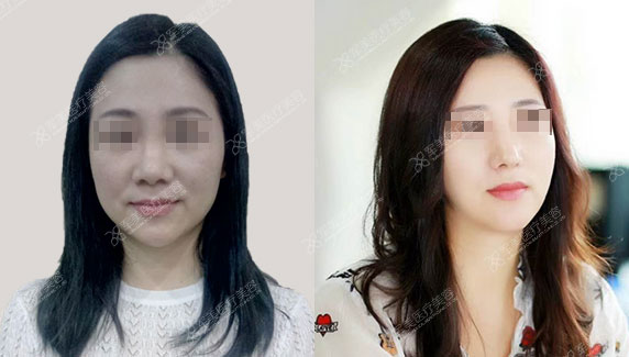 鼻部修复手术需要注意什么
