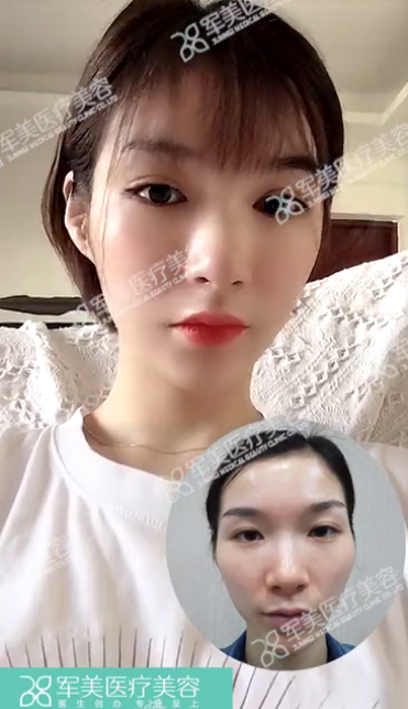 自体脂肪填充面部能维持一辈子吗
