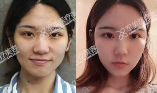 如何提高自体脂肪填充的存活率