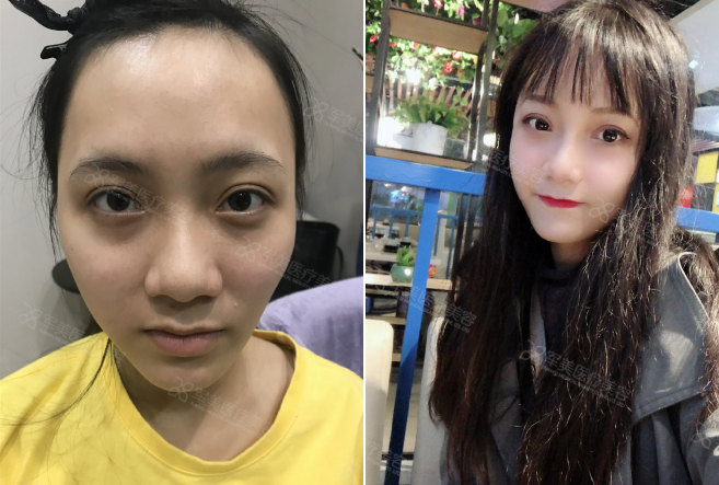 自体脂肪填充能维持多久