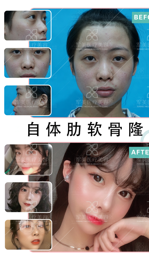 自体肋软骨隆鼻