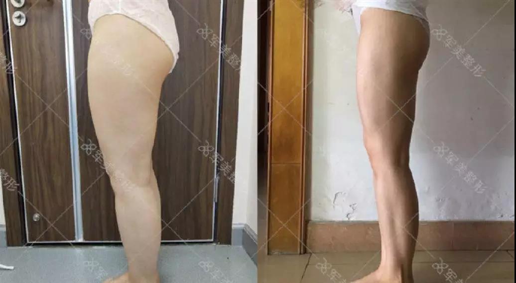 大腿吸脂