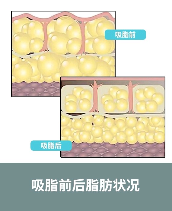 吸脂减肥